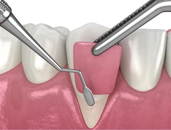Periodontic / Gum Surgeries